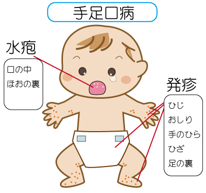 ニュースレター Vol 34 手足口病 お知らせ トピックス にしおかクリニック